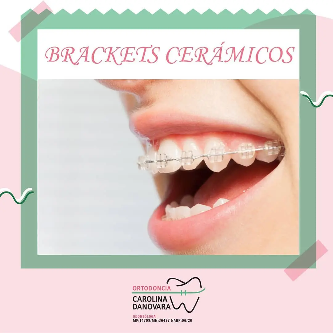Brackets Estéticos
