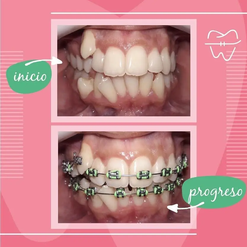 Caso antes y después con brackets - Adulto
