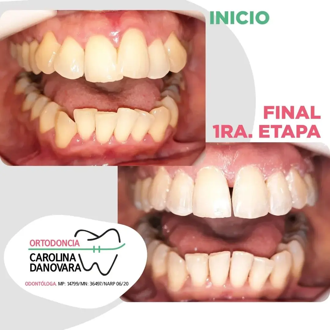 Caso antes y después con brackets - Adulto